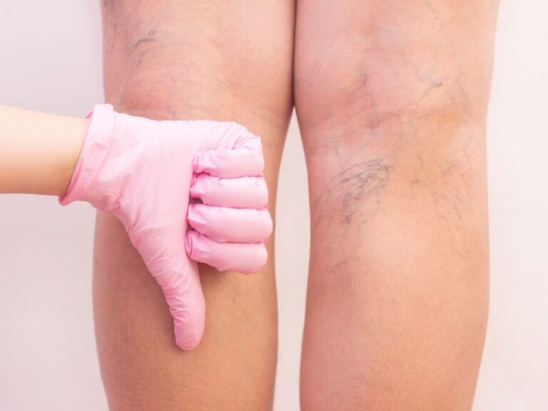 Bacakta Çatlamış Damar Neden Olur ve Nasıl Geçer?